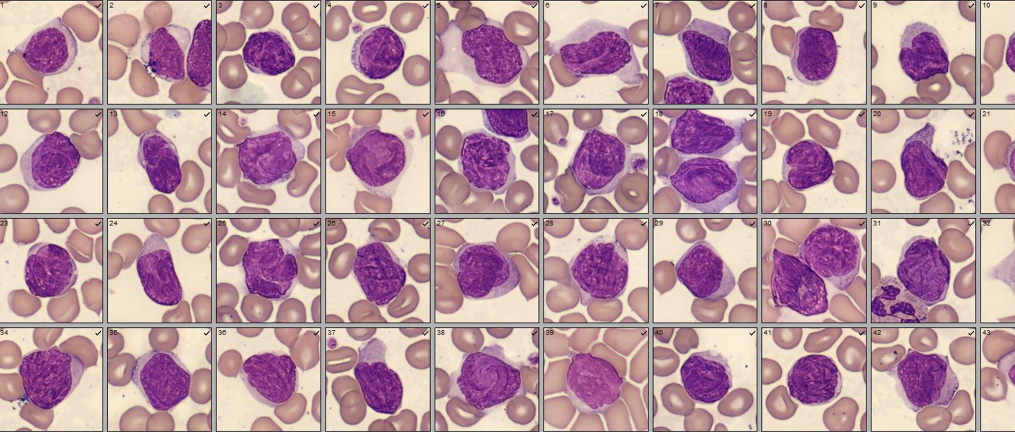 sezary cells