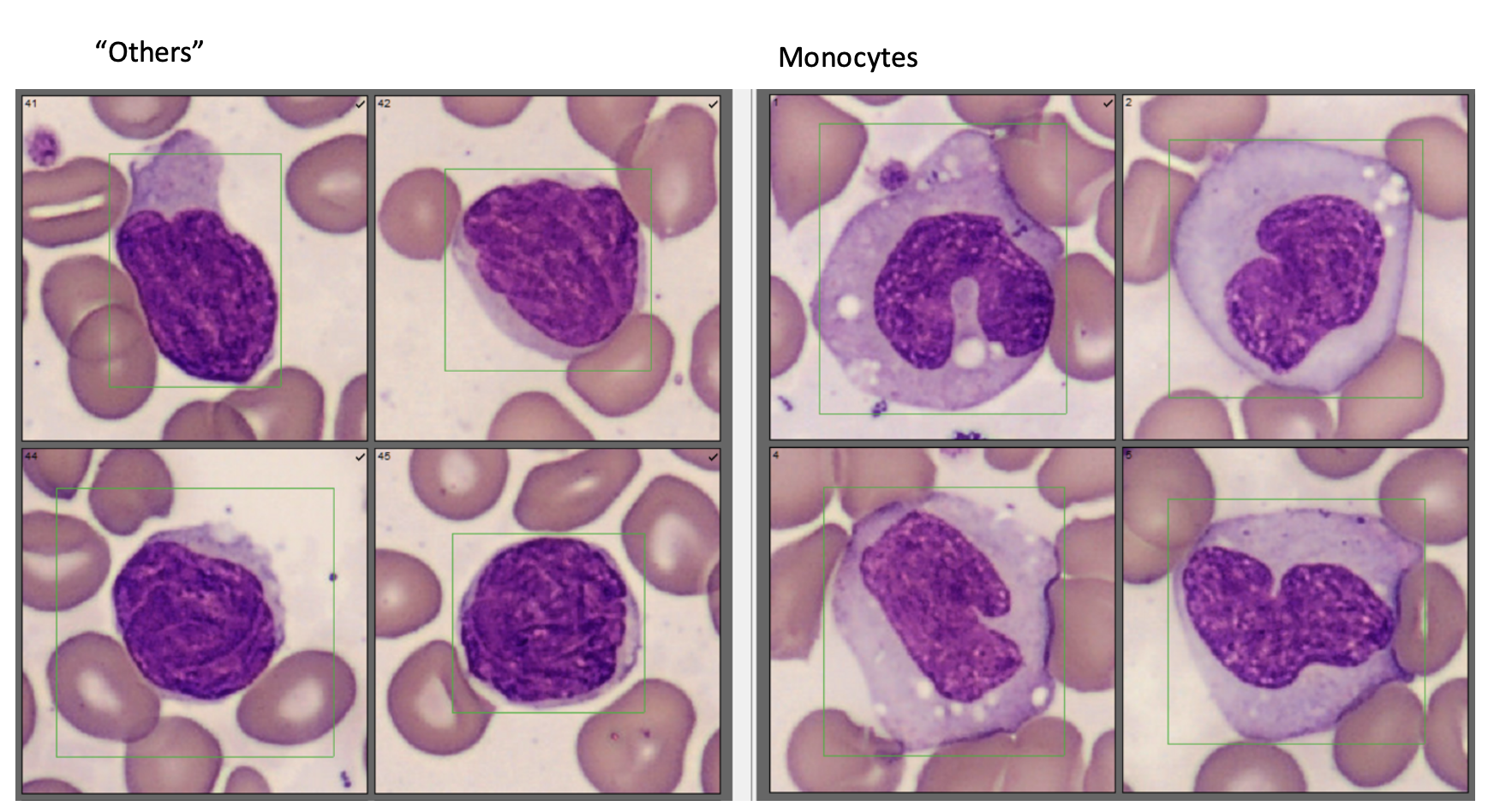 sezary cells