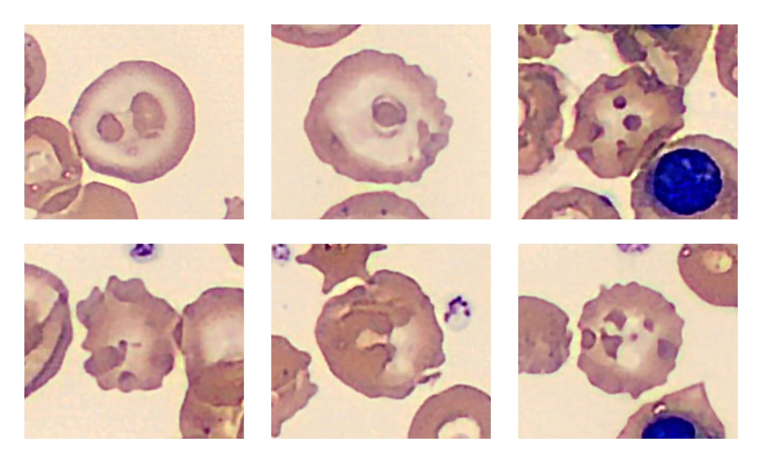 Composite cells illustrating patient case about Thalassemia