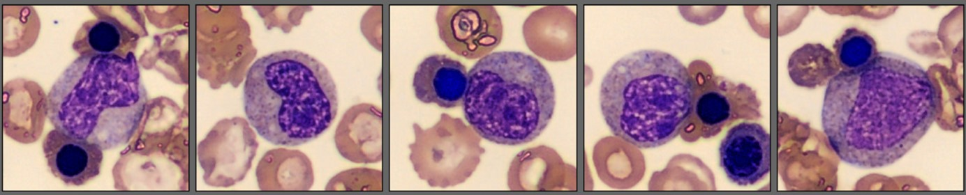 Metamyelocytes and Myelocytes - Patient case Thalassemia