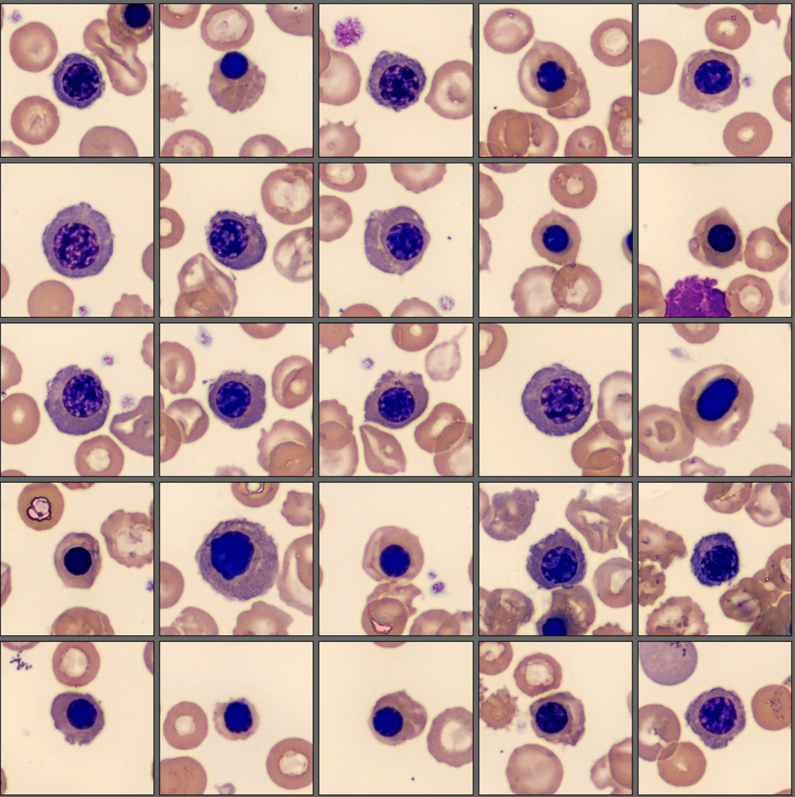 NRBCs - Patient case Thalassemia