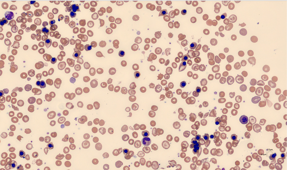 RBC morphology - Patient case Thalassemia