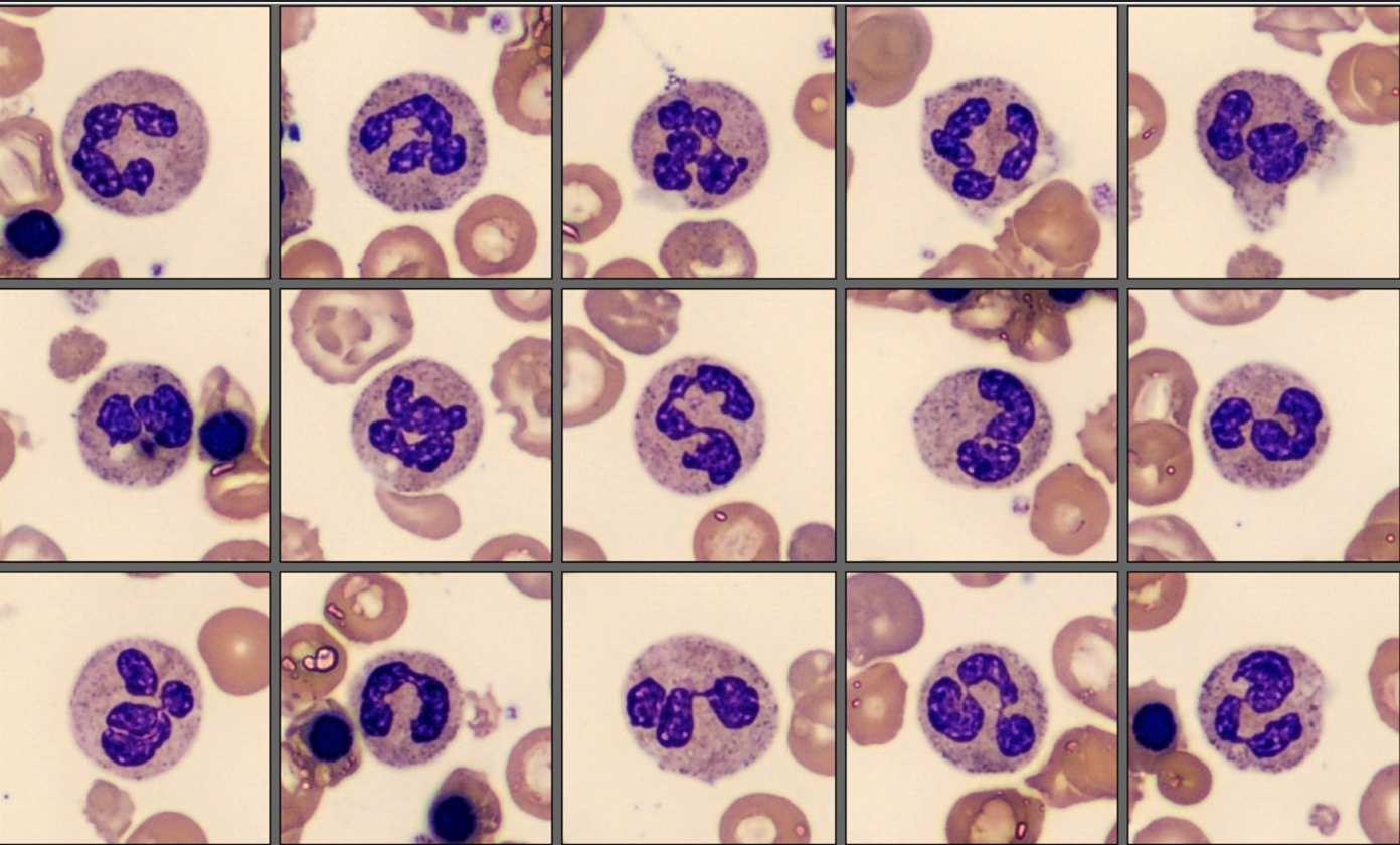 Segmented neutrophils - Patient case Thalassemia