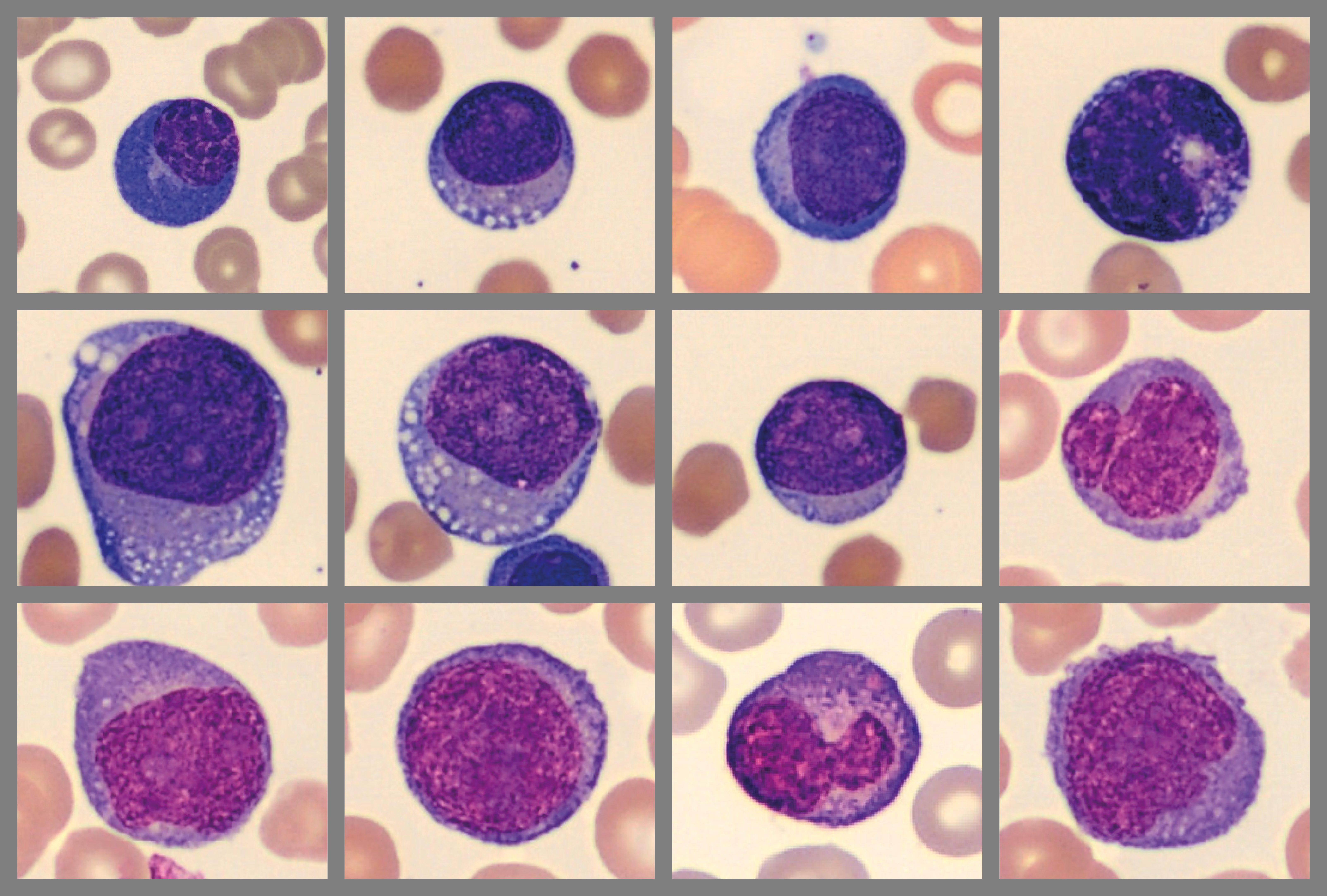Composite cells illustrating patient case 4
