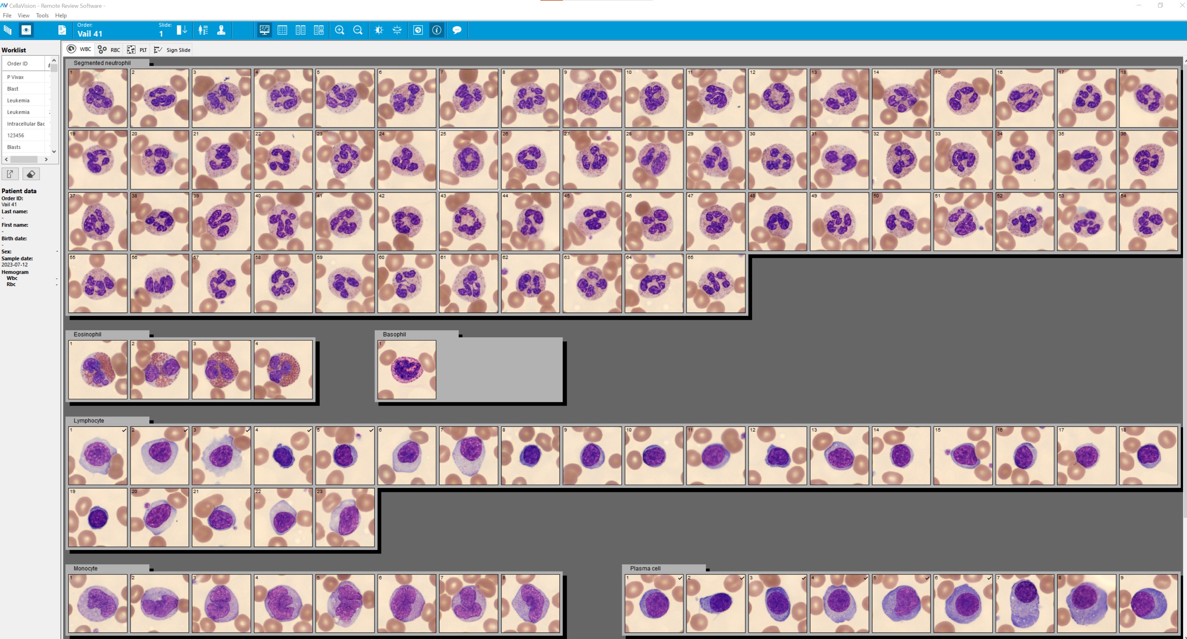 Patient case 4: plasma cell leukemia CellaVision screenview