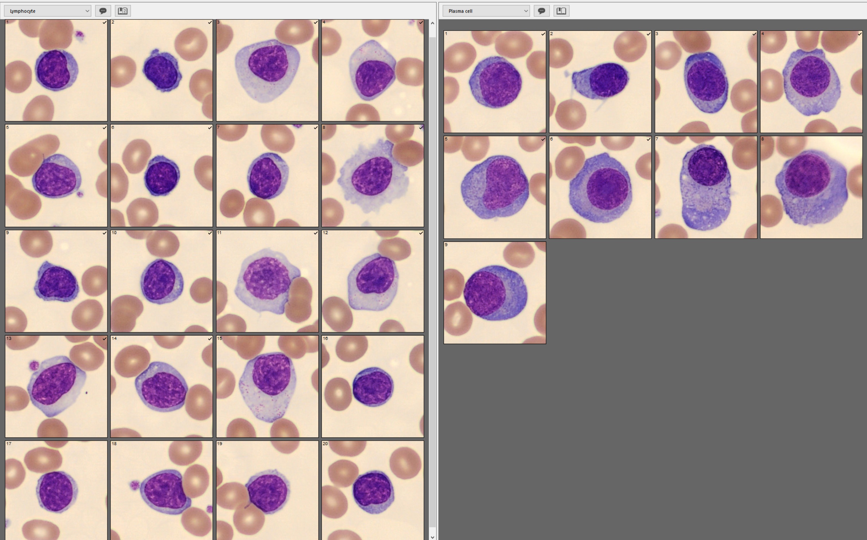 Lymphocytes vs plasma cells - side-by-side view with CellaVision DC-1