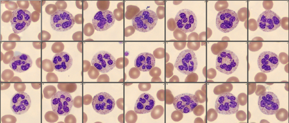 Hypersegmented neutrophils 