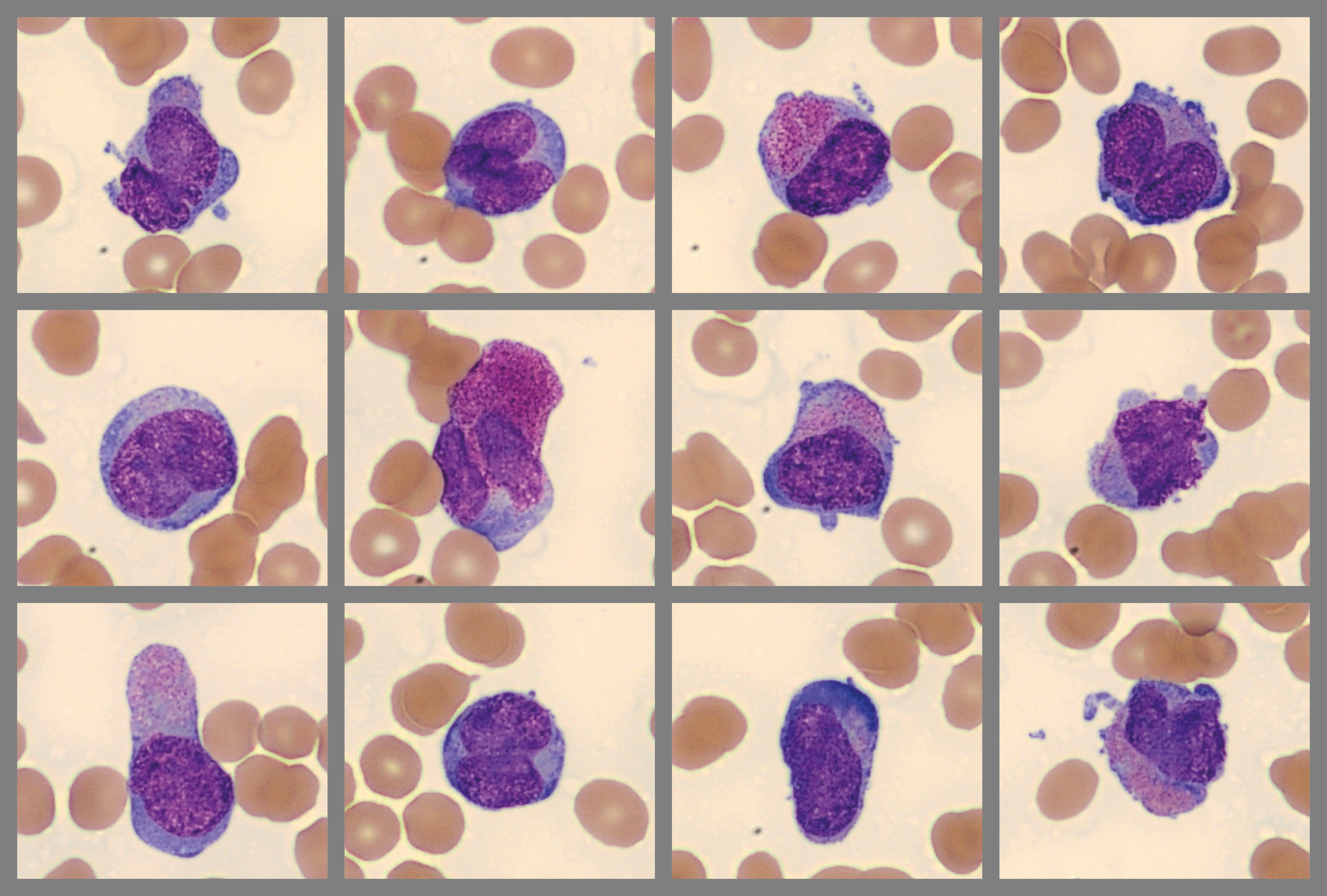 Acute Promyelocytic Leukemia - cells from patient case
