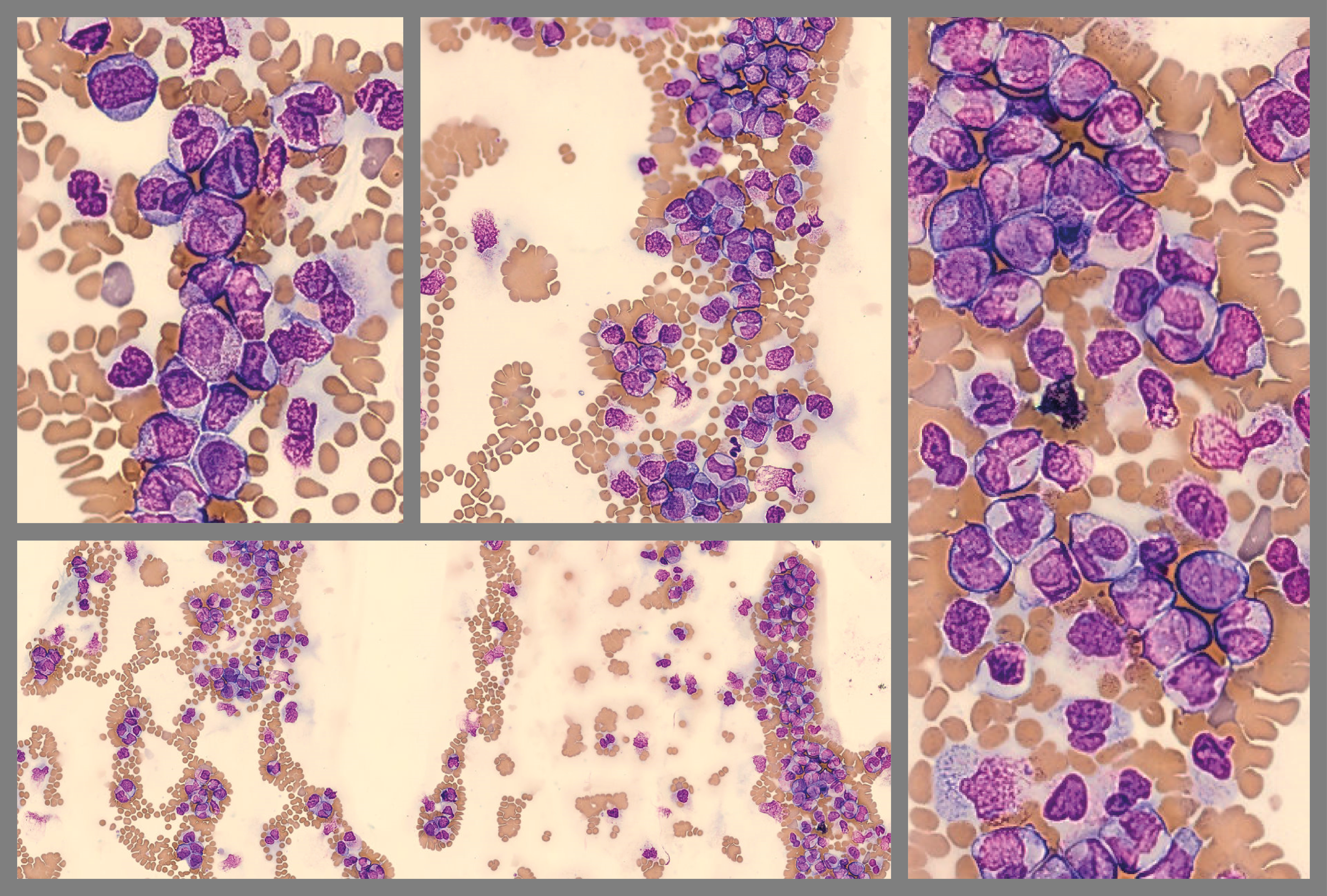 Feathered Edge pictures from CellaVision DC-1 illustrating patient case 5 