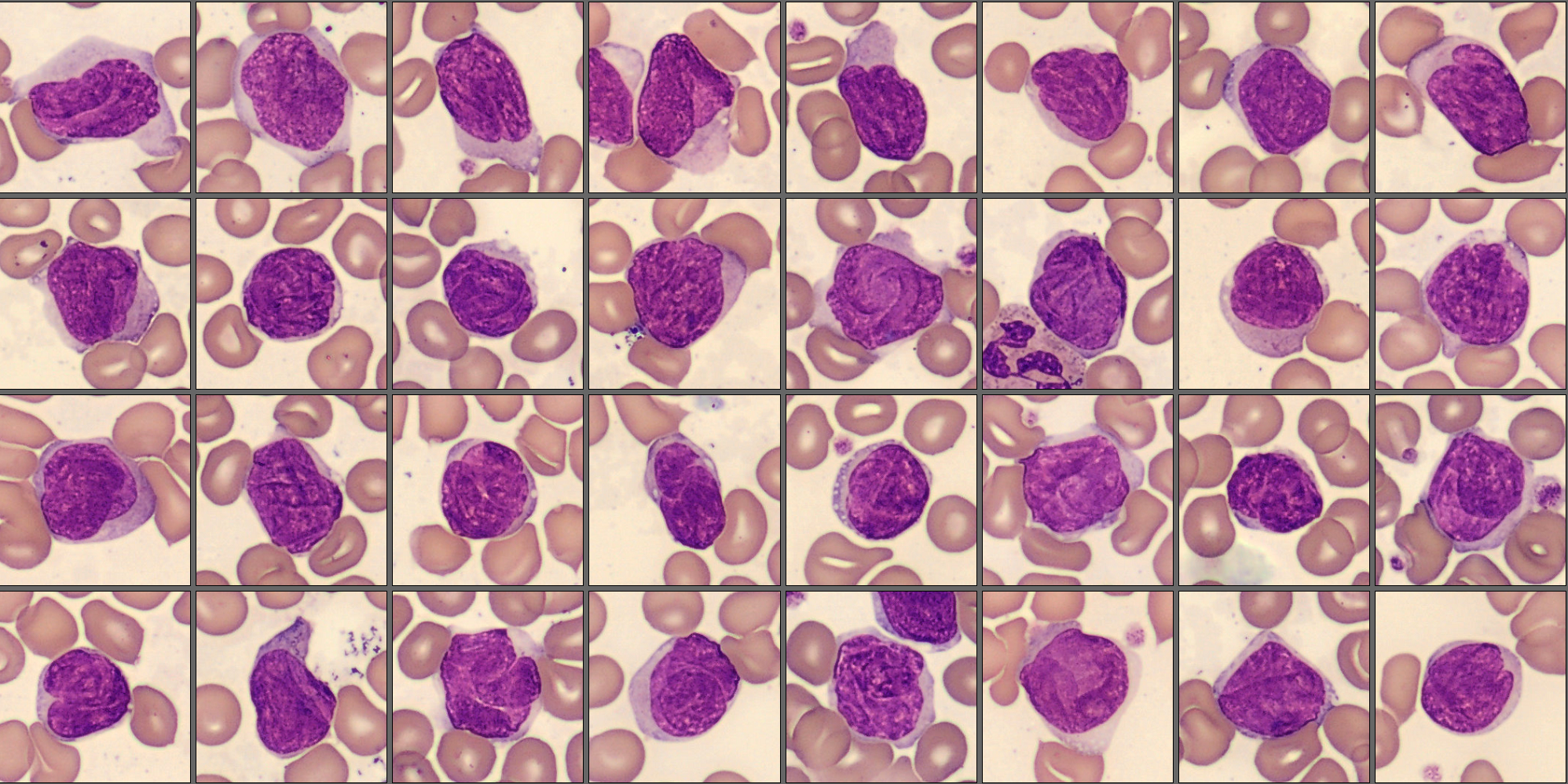 Abnormal lymphocytes Monthly Cell Challenge May 2025
