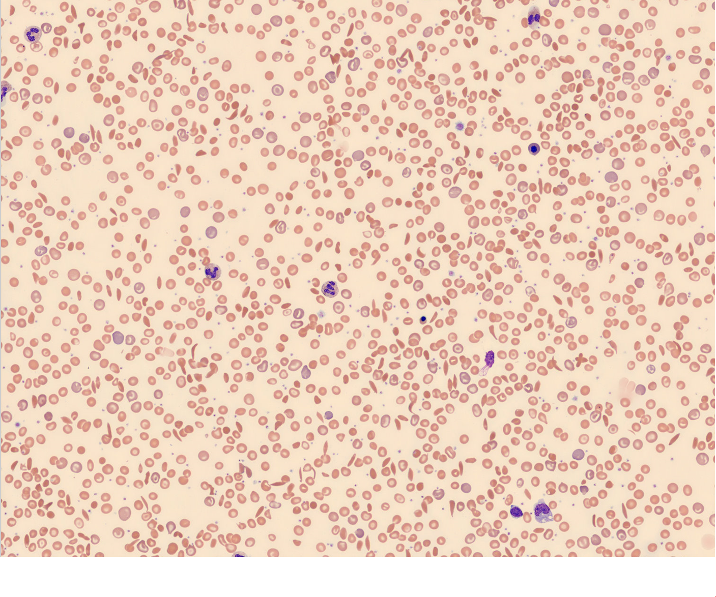 RBC large patient case 9