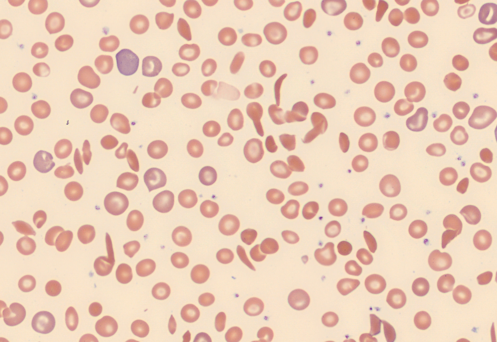 RBC patient case 9