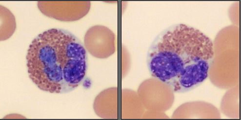 Eosinophils from the CellaVision Monthly Cell Challenge June 2025