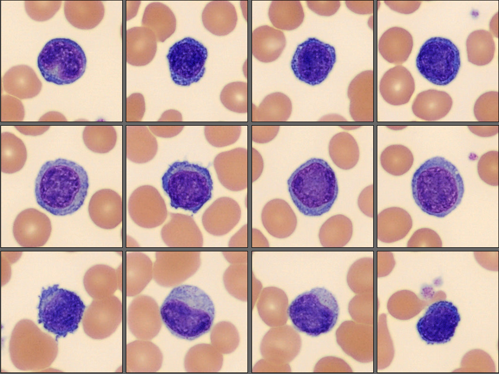 Lymphocytes from the CellaVision Monthly cell challenge June 2025