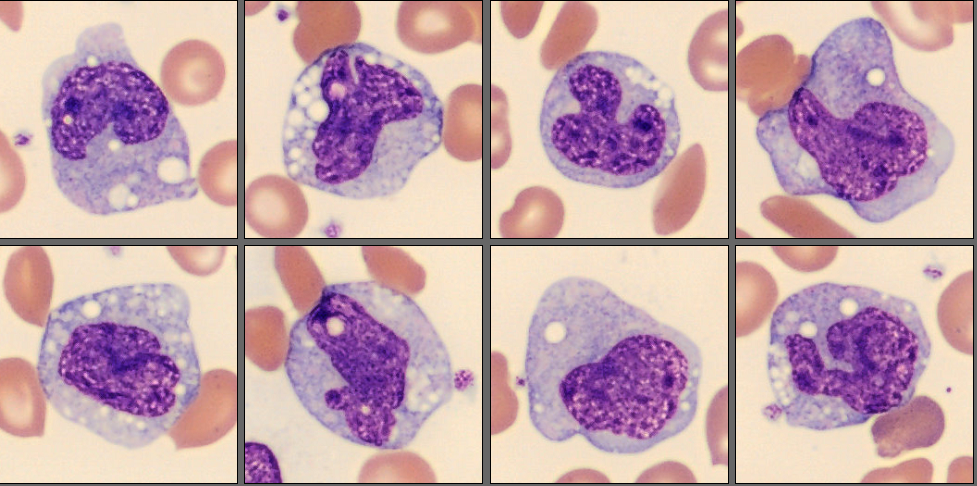 Monocytes patient case 9