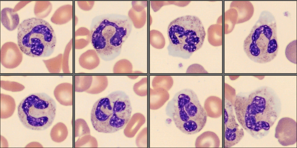 Neutrophils from patient case 9