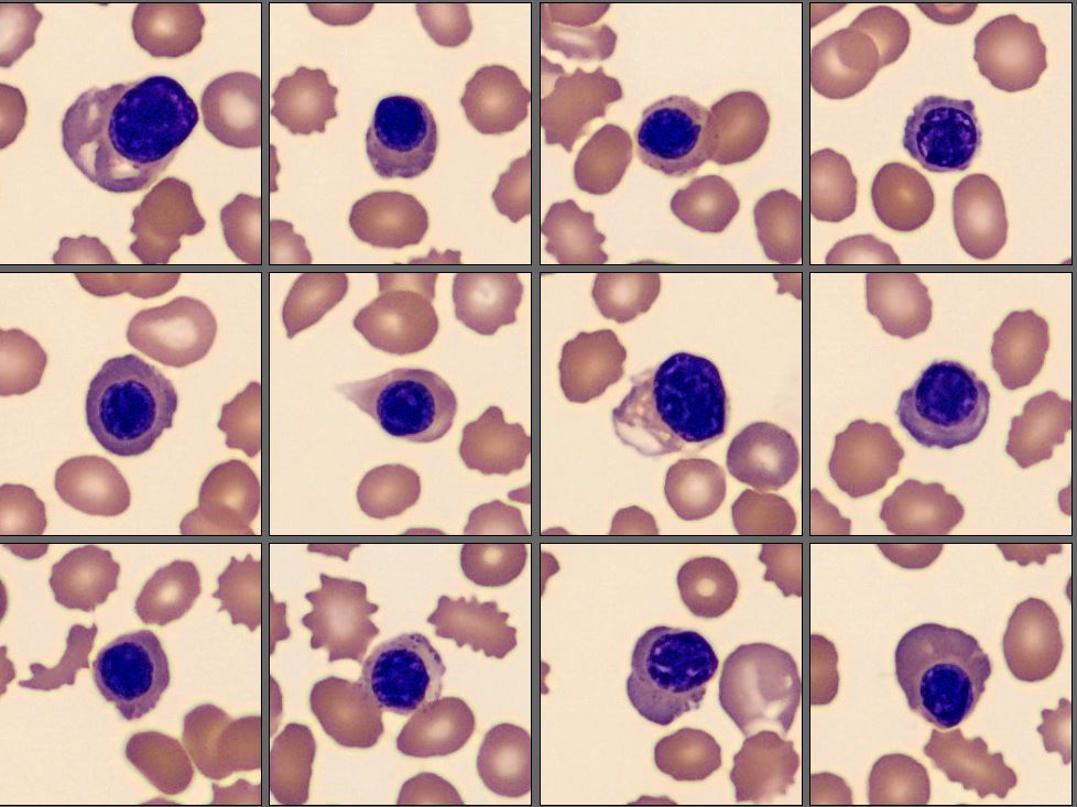 NRBC from the CellaVision Monthly Cell Challenge July 2025