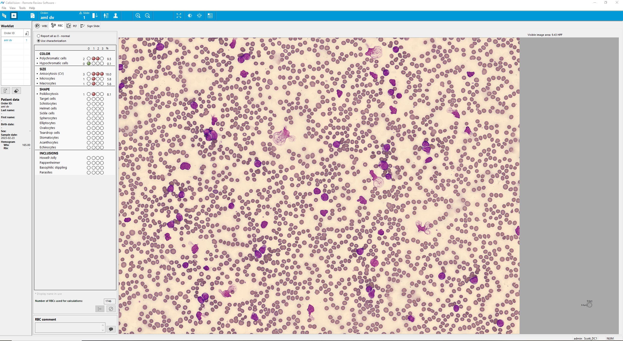 Overview RBC patient case Acute Myeloid Leukemia with NPM1 and FLT3-IDT mutation