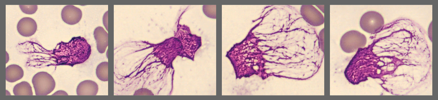 SMU from patient case Acute Myeloid Leukemia with NPM1 and FLT3-IDT mutation