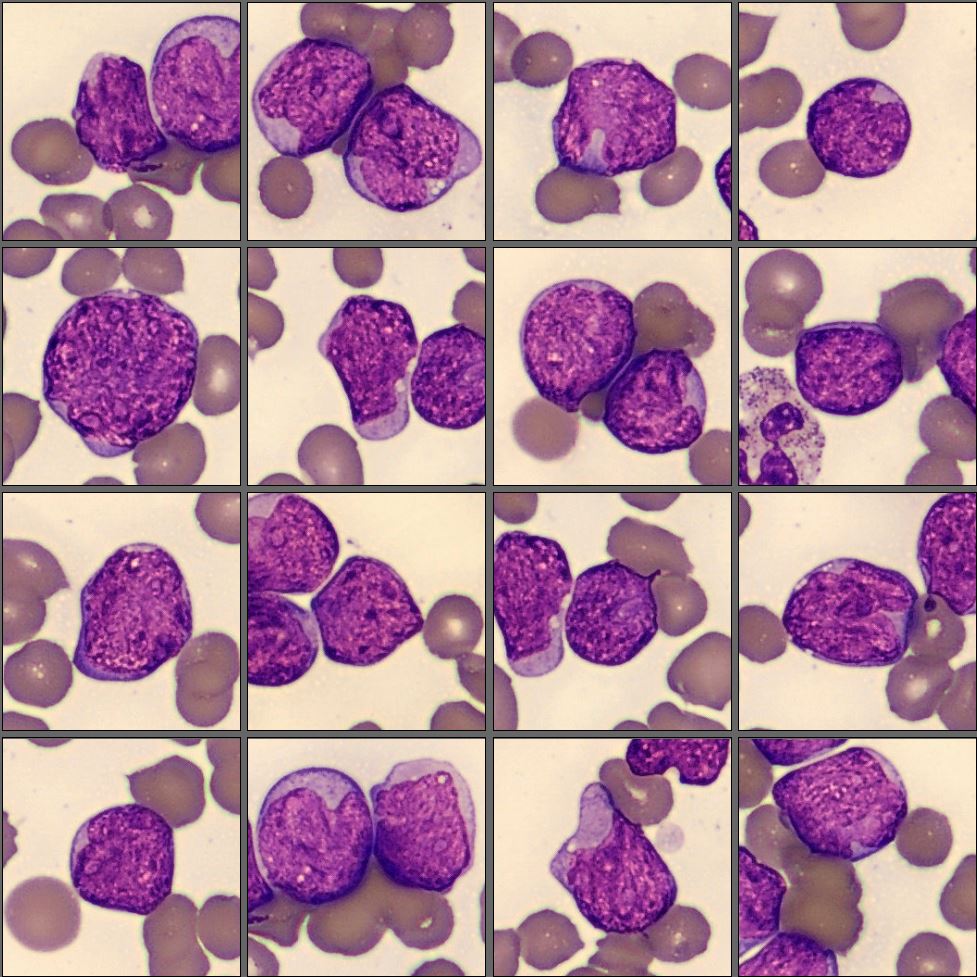 Blasts Acute Myeloid Leukemia