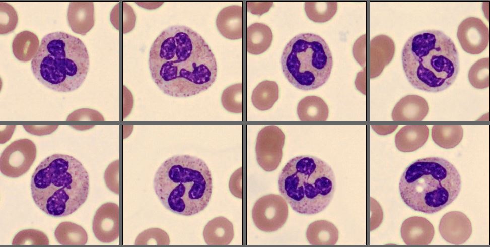 Neutrophils CellaVision Patient Case 4 2025