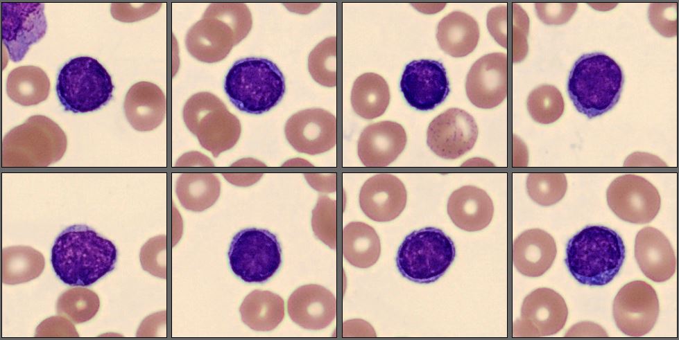 Lymphocytes CellaVision Patient Case 4 2025
