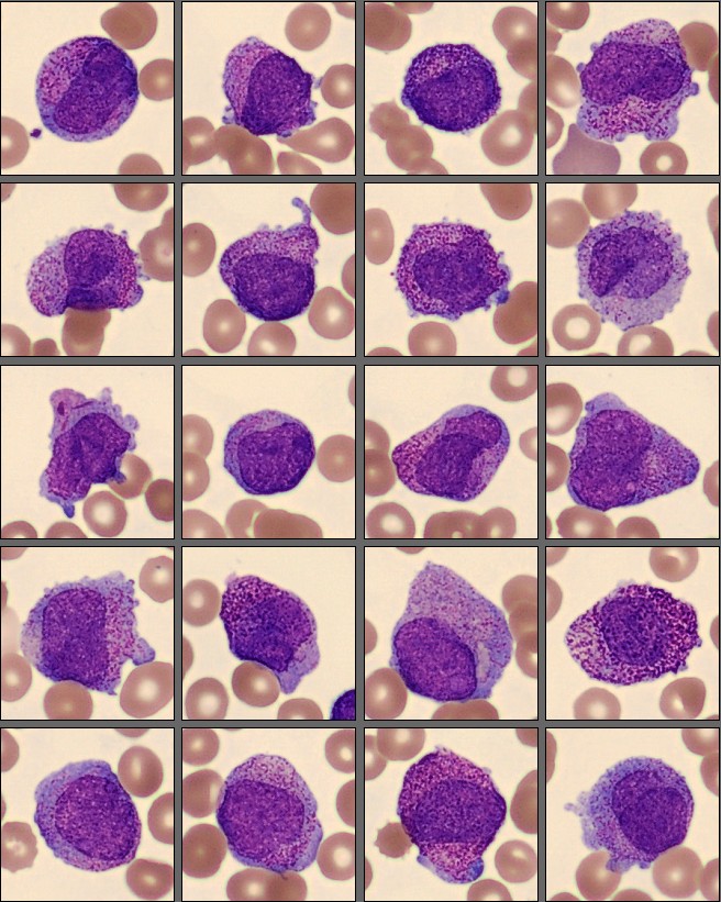 Promyelocytes from CellaVision Patient Case 4 2025