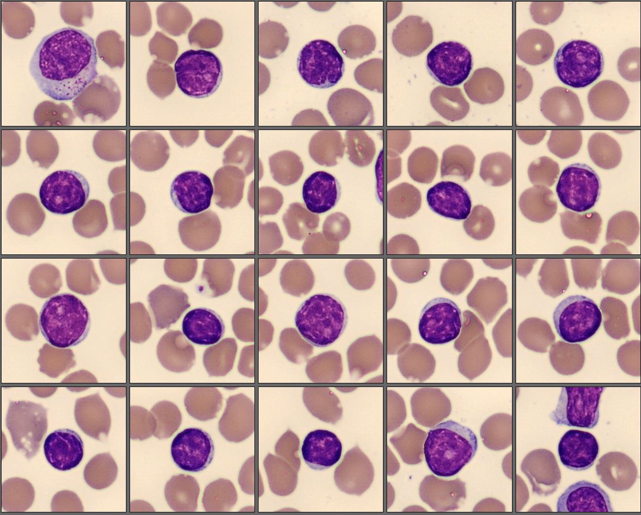 Lymphocytes CellaVision Monthly Cell Challenge January 2026