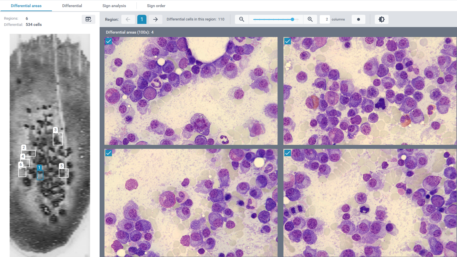 Monthly Cell Challenge #3 2026 CellaVision® Bone Marrow Aspirate Application 