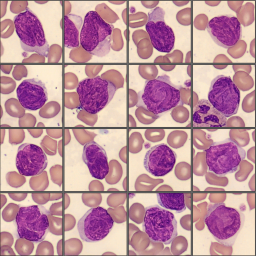 Abnormal lymphocytes Monthly Cell Challenge May 2025