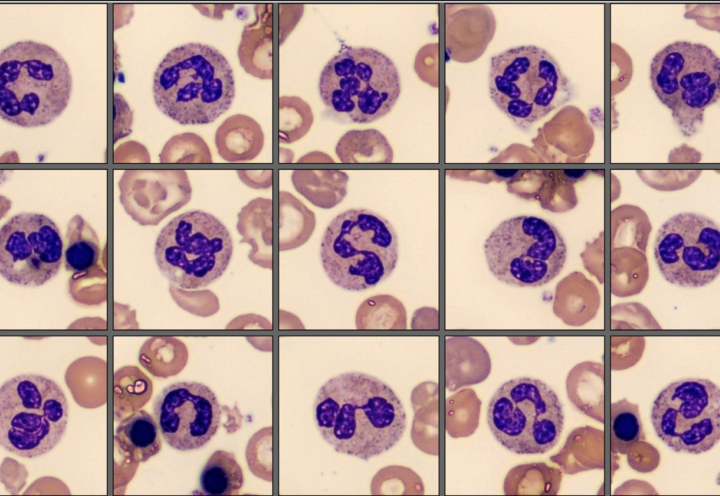 Segmented neutrophils - Patient case Thalassemia
