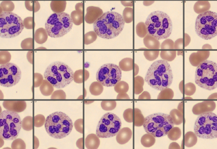 Hypersegmented neutrophils