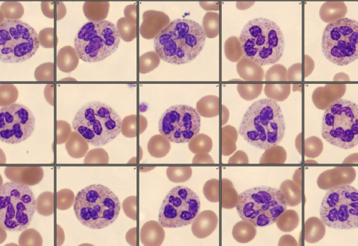 Hypersegmented neutrophils 