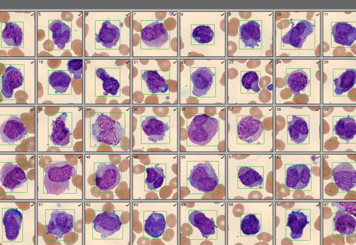 Cells from Patient Case 5