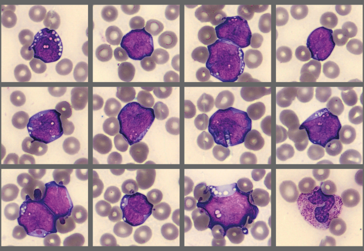 Cells from patient case Burkitt’s Lymphoma