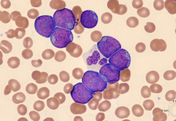 acute leukemia from cell challenge november 2024