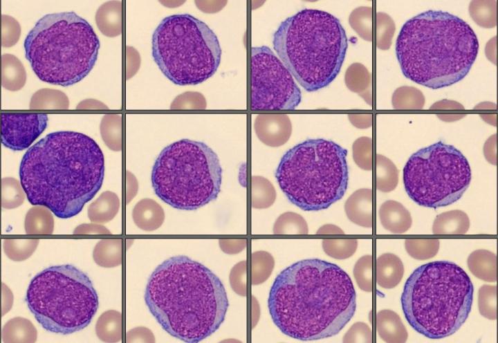 Blasts Mantle Cell Lymphoma