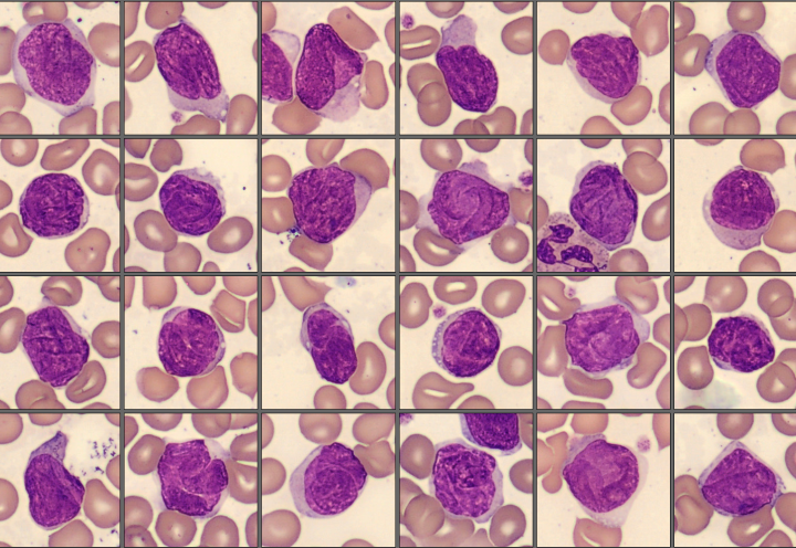 Abnormal lymphocytes Monthly Cell Challenge May 2025