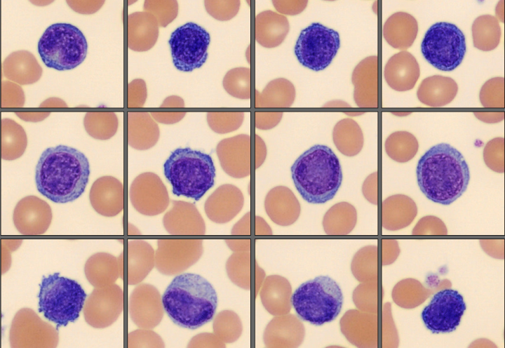 Lymphocytes from the CellaVision Monthly cell challenge June 2025