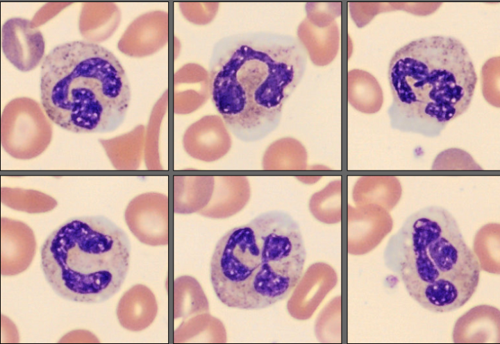 Neutrophils from patient case 9