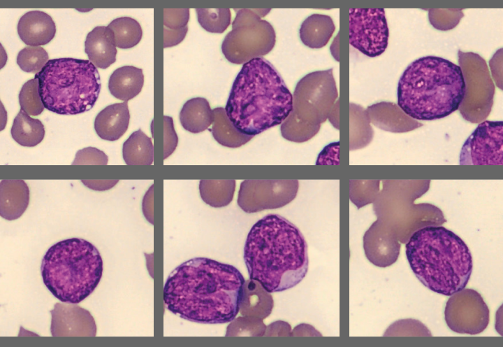 Blasts Acute Myeloid Leukemia 2025