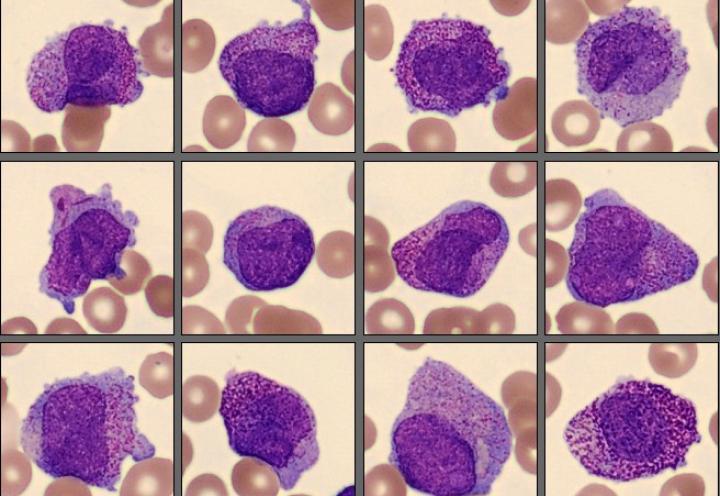 Promyelocytes from CellaVision Patient Case 4 2025