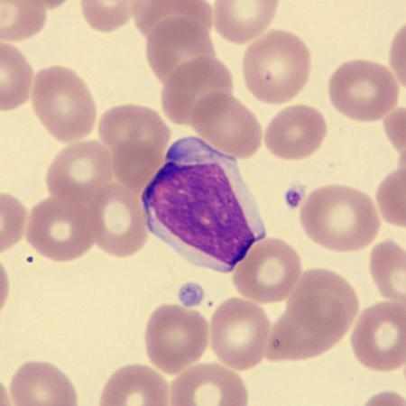 Largelymph1