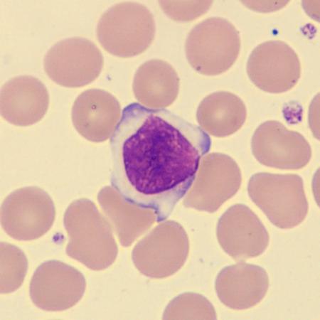 Largelymph3