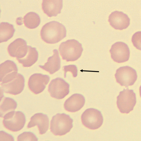 Schisto5