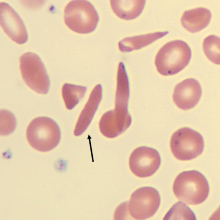 Sickle1