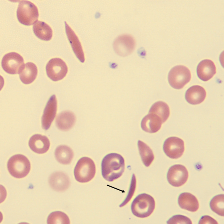Sickle6