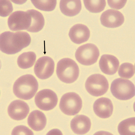 Stoma5