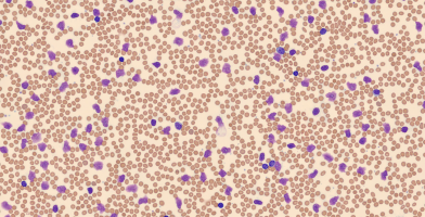 Smudge Cells